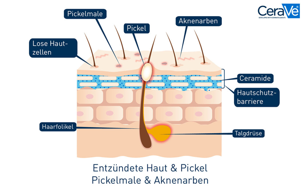 Grafik mit dem Aufbau einer Haut mit ausgeprägter Akne